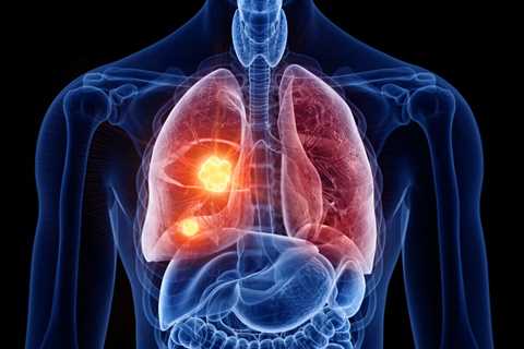 Small Cell vs. Non-Small Cell Lung Cancer