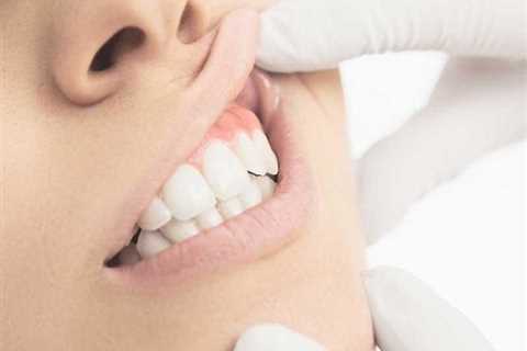 My Front Teeth Are Loose - What Are Natural Remedies? - Receding Gums Treatment Options