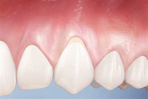 Exposed Tooth Root Fix - Receding Gums Treatment