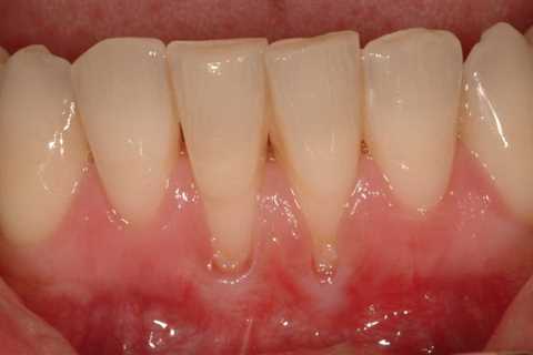 Decayed Tooth Exposed Tooth Root - Receding Gums Treatment