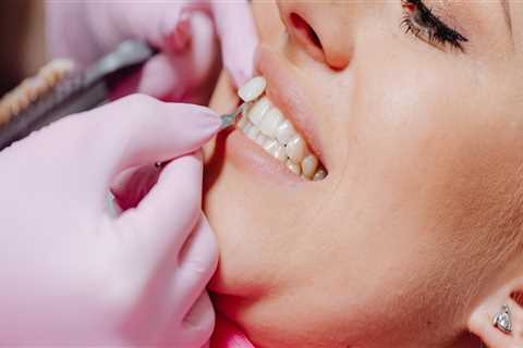 A Comprehensive Guide To Dental Veneers In Cedar Park: Is It Right For You