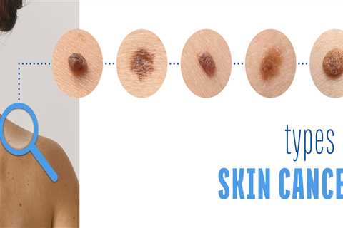 What is Melanoma? A Comprehensive Guide to Skin Cancer
