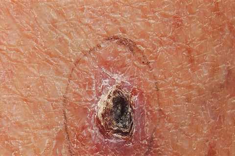 Basal Cell Carcinoma: A Comprehensive Guide to Skin Cancer