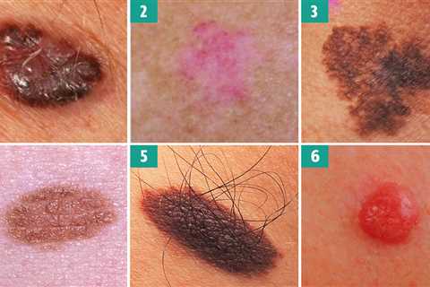 Can you spot the deadly moles from the harmless ones? The skin cancer signs you must never ignore