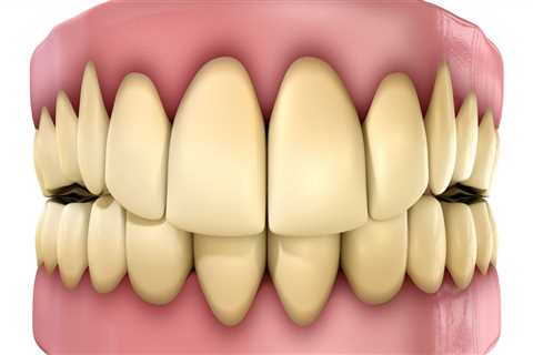 Discoloration Risks: A Comprehensive Overview