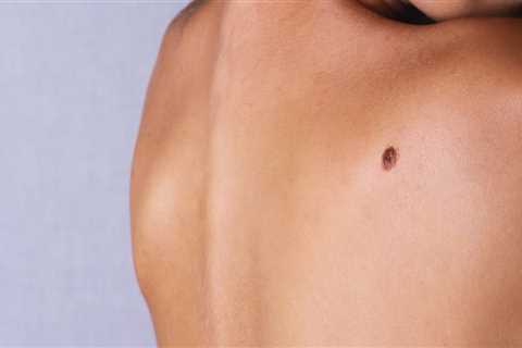 Ligation and Excision: A Guide to Skin Tag Removal