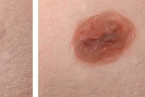 Understanding Scarring Risks After Mole Removal