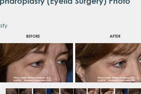 The Seattle Eyelid & Blepharoplasty Center
