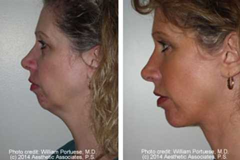 Facelift & Chin Implant Photo Gallery