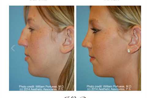 The Portland Center for Facial Plastic Surgery : Rhinoplasty, Facelift Surgery