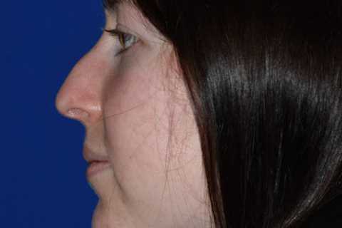 The Portland Center for Facial Plastic Surgery : Rhinoplasty, Facelift Surgery