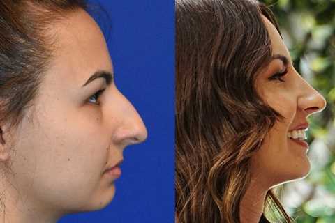 Rhinoplasty: The Long and Short Story