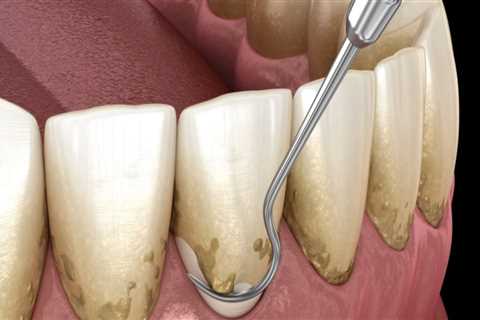 Can periodontitis be removed?