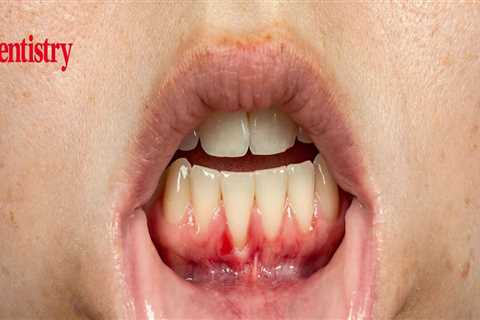 What can I do to prevent periodontal disease?