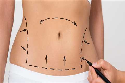 Exploring Which Treatment In Nashville Is Right For You: CoolSculpting Or Laser Liposuction