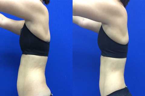 Is laser liposuction permanent?