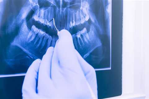 Do dental x-rays have a lot of radiation?