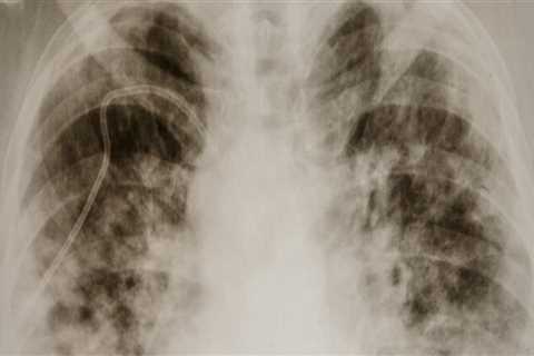 The Risks of Delta 8 on Lung Health