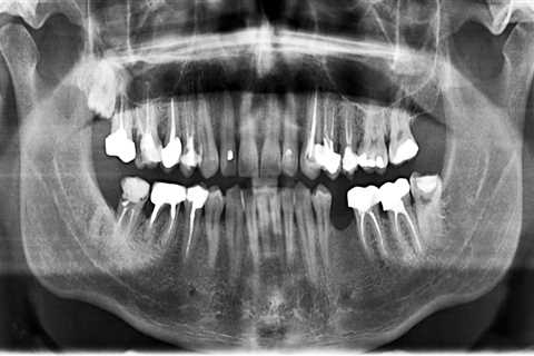 How do i ask for dental x-rays?