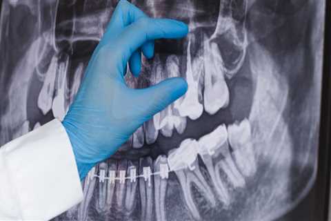 How To Determine If You Need A Dental X-ray Before Visiting A Dentist In New Jersey