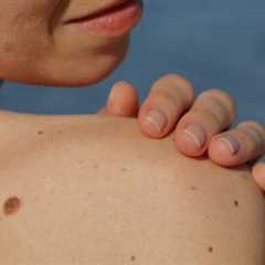 Preventing Skin Cancer: Expert Tips and Advice