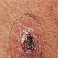 Understanding Skin Cancer Prognosis: What You Need to Know