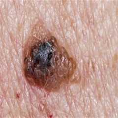 Everything You Need to Know About Skin Cancer: A Comprehensive Guide
