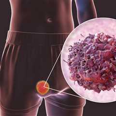 Testicular cancer more likely in millions of Brits with common conditions – are you at risk?