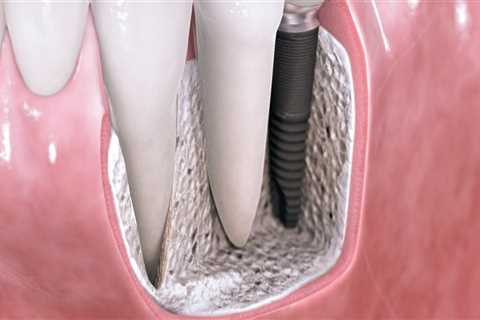 Does general dentistry include implants?