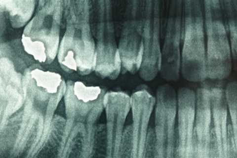 Where are dental x-rays produced?