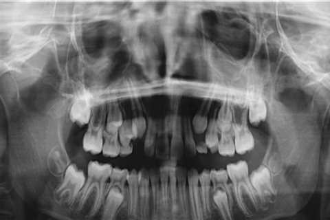 What does a full mouth x-ray show?