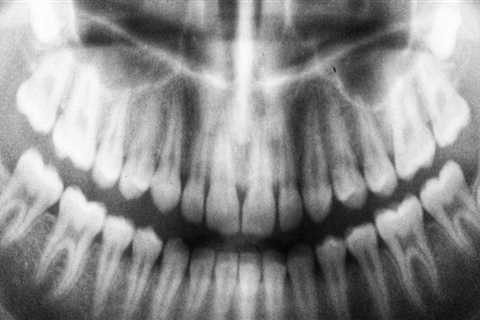 Are dental x-rays bad for you?