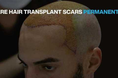 Hair Transplant In Indore - The Facts