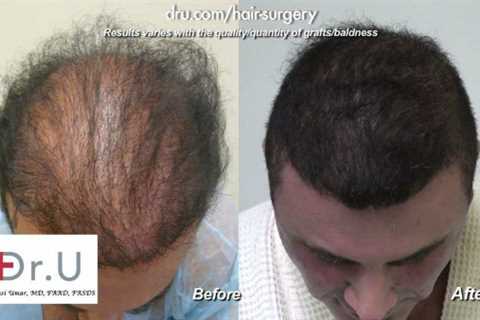 Getting My Hair Transplant In Indore To Work