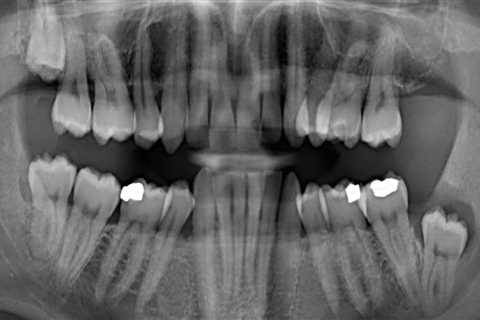 Why Do Emergency Tooth Extraction Procedures Need Dental X-Rays In London