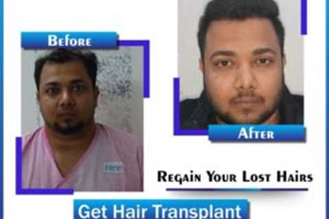 5 Easy Facts About Hair Transplant In Indore Described