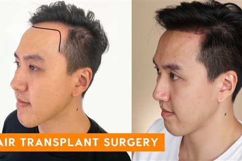 The Facts About Hair Transplant In Indore Revealed
