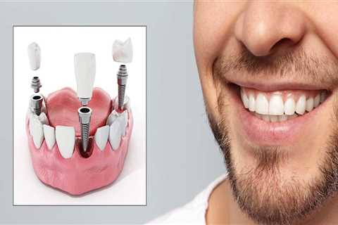 General Dentistry: All You Need To Know About Dental Implants In Beverly Hills, CA