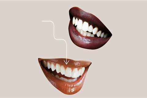 Can veneers be done twice?