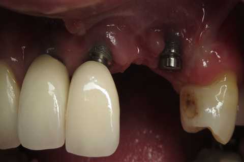 Can dental implants fall out?