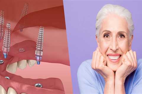 The Definitive Guide To Dental Implants In Spring, TX: All You Need To Know As A Patient