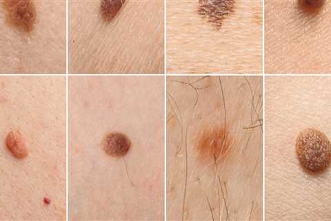Understanding Melanoma: What You Need to Know