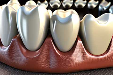 Compassionate & Professional Dental Bridges at Anderson Dental Professionals in Lakes of the..