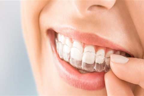 Do Clear Aligners Damage Teeth?