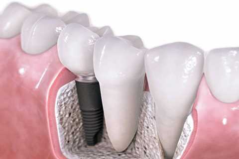 Standard post published to Symeou Dental Center at March 12, 2023 10:00