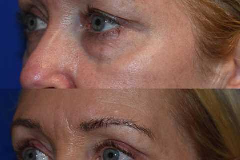 The Seattle Eyelid & Blepharoplasty Center