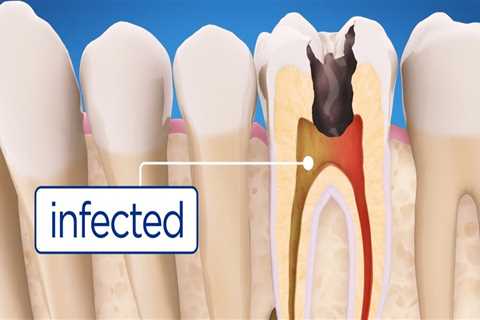 What is the Difference Between Endodontics and Root Canal?