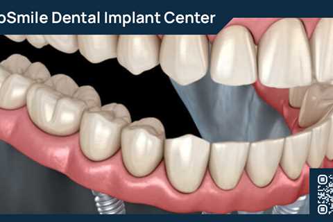 Standard post published to ProSmile Dental Implant Center at April 16, 2023 16:02