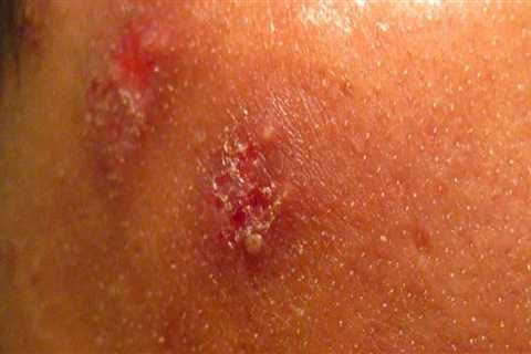 Everything You Need to Know About Shingles