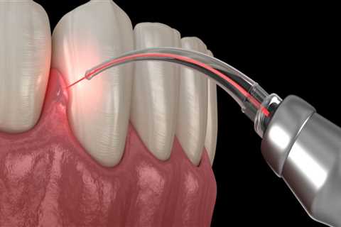 Can I Get a Dental Laser Cleaning for Gum Disease?